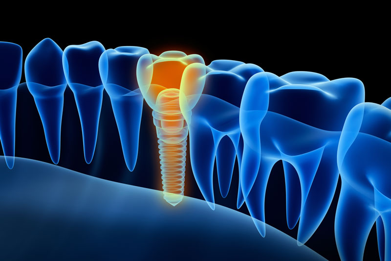 Benefits Dental Implants